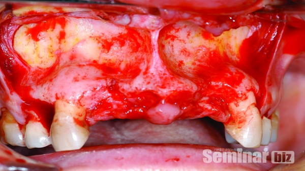 ▲ Figure 6-2. #11,#21을 발거하고 상악 치근단 부위의 alveolar bone과 basal bone의 위축현상이 심하여 골이식이 필요한 상황이다.