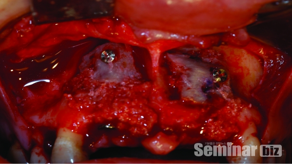 ▲ Figure 6-5. 장골의 corticocancellous bone을 이식하고 주변의 gap이 발생하거나 열개가 발생할 경우에는 골수일부를 채취해서 채워넣는 형태로 골이식을 시행한다.