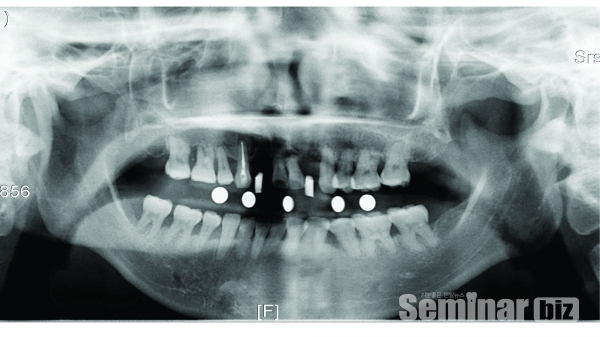 ▲ Figure 6-7. 초진 방사선사진이면서 stent 이용한 파노라마 사진