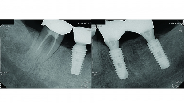 ▲ Figure 6(2)-8. #46 flapless implant, #36, #37 bone grafting과 함께 임플란트 식립이 이루어짐
