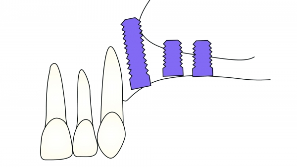 ▲ Figure7-2(1) 잔존치조골에 임플란트를 식립하면 짧은 임플란트 식립이 요구되거나 좋지 않은 implant/crown ratio를 갖는다. Only bone graft는 골의 부피를 증가시키고, 긴 임플란트를 식립할 수 있을 뿐만 아니라 보철물의 높이도 감소시킬 수 있다.