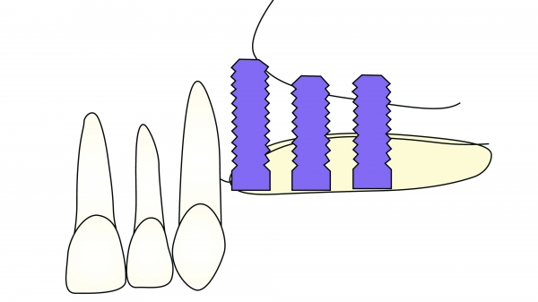 ▲ Figure 7-2(2) Onlay graft를 시행하면 잔존 치조골에 임플란트의 초기 안정성을 얻기에 충분한 골을 제공한다. 이런 상황에서는 연조직의 봉합이 어렵다.
