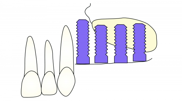 ▲ Figure 7-2(3) 상악동거상술을 통하여 상악구치부위에 임프란트를 식립하기 위한 개선방법으로 lateral window technique이나 lateral grooving technique을 이용하여 상악동저에 골이식을 시행할 수 있다.