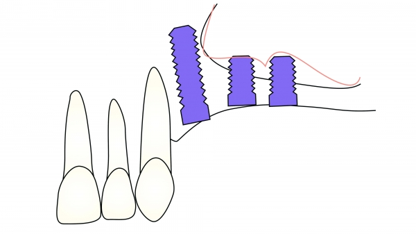 ▲ Figure 7-2(4). 상악동저는 Summers' technique을 사용하여 각 osteotomy site에서 거상시킬 수 있다. Osteotome으로 치근단에서 bone plug를 밀어 올림으로써 상악동 점막은 건전한 상태로 있으면서 상악동저가 infracture될 수 있다.