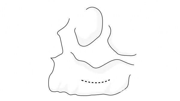 ▲ Figure 7-8(2) Lateral grooving을 모습을 보여 주고 있으며 Alveolar ridge에서 5-10mm 내외에 2mm diamond bur를 이용하여 삭제하면서 membrane이 노출되도록 한다.