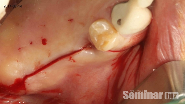 ▲ Figure 7-9(3). 치조정부위의 incision을 시행한 모습으로 약간은 palatal에 치우쳐서 시행하고 있음.