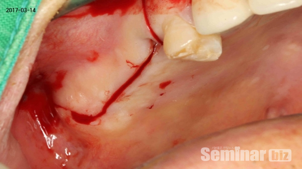 ▲ Figure 7-9(4) cut back incision을 #15 distal 부위에 vertical round형 태로 시행한 모습