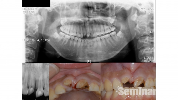 ▲ Figure 8-1 #11,#21 crown and root fracture와 함께 치열이 고르지 않은 상태의 치아로 발거하면서 immediate postextraction implantation을 고려하고 있다.