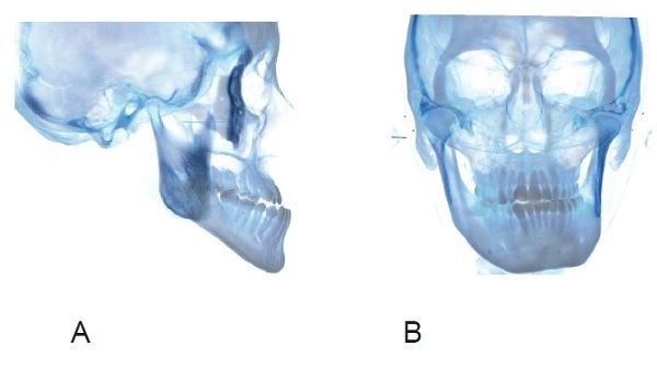 ▲ 그림 1. 턱수술후 하악골의 위치변화가 우려되는 경우. 선수술이든 아니든 관계없이 하악전돌의 정도가 심한 경우(A) 또는 비대칭이 심한 경우(B)에는, 수술 자체의 relapse에 의해 하악골의 위치변화가 나타날 수 있다.