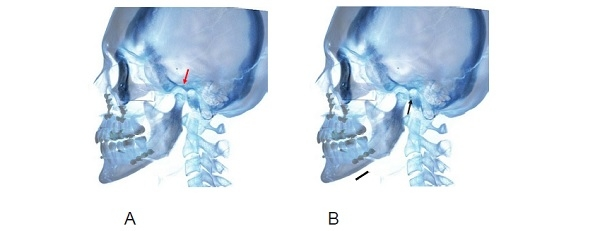 ▲ 그림 7. 수술에 의한 과두전위 발생에 대한 대처. 수술에 의한 과두전위는 어느 정도 불가피하게 나타남으로 대처 방법에 대한 이해가 반드시 필요하다. A. 좌측 과두가 심하게 전하방으로 전위된 경우이다. B. 과두가 제위치로 돌아가려는 경향에 의해 근심골편 뿐 아니라 원심골편도 움직인다면 하악골의 위치, 나아가 수술교합의 변화가 초래된다. 따라서 과두는 제위치로 reposition 되게끔 허용하고 원심골편의 위치 나아가 수술교합은 유지되게끔 조치를 해 주어야 한다.