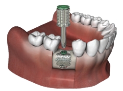 ▲ EZ Fixing System 임상 이미지