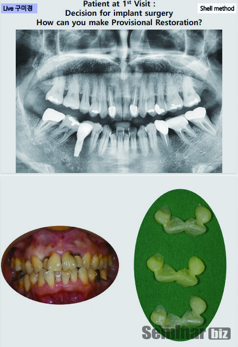 레이의 솔루션으로 임시치아의 껍질을 출력한  전인성원장의 환자 케이스