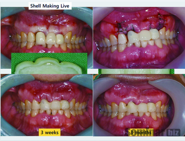 임시치아제작 케이스 (제공 전인성 원장)