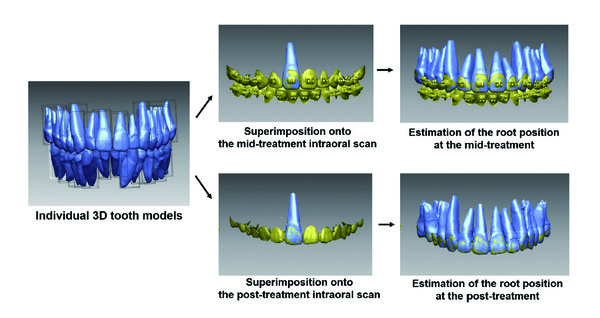 구강 스캔만으로도 치근을 포함한 3차원적 치아 이동양상 평가가 가능한 영상분석법 모식도