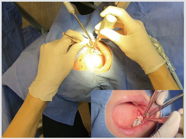 (그림) 필드만 주시하면서 또한 필드를 유지하면서 매복 하악 좌측 제3 대구치 발치를 시행하고 있는 과정을 술자의 시선 (메인 화면)과 제 3자의 시선(보조 화면)좀 더 자세히 알고자 하는 분들은 아래의 동영상을 참고하시기 바랍니다.https://youtu.be/zF1oSRYyJmM