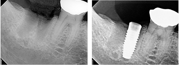 식립 전(좌) 후(우)의 모습