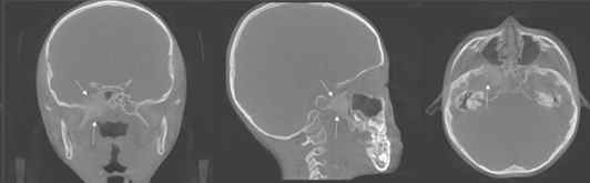 6세 남아의 오른쪽 접형동에 생긴 섬유형성이상 분석 영상이미지
