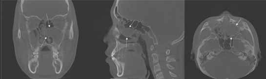 14세 남아의 왼쪽 상악동에 생긴 점액낭종 분석 영상이미지