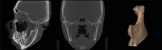 턱관절 퇴행성 골관절염 분석 영상이미지