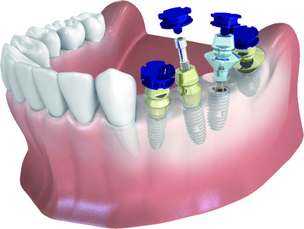 △ 네오바이오텍의 ‘PickCap 임플레션 시스템