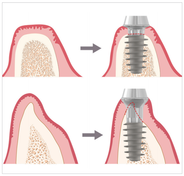 (그림 2-1, 2-2) 골폭에 따른 Magi Cuff의 적용