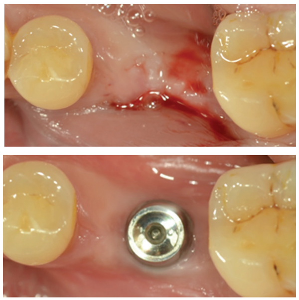 (그림 3) 좁은 골폭에서 MagiCore 식립