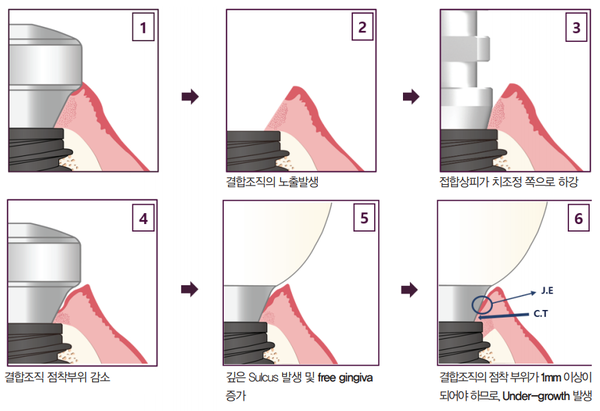 (그림 4) Bone level 2-piece 임플란트 시스템의 인상 채득 및 crown setting 과정