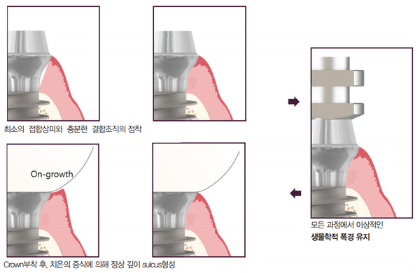 (그림 5) MagiCore 임플란트 시스템의 인상 채득 및 crown setting 과정