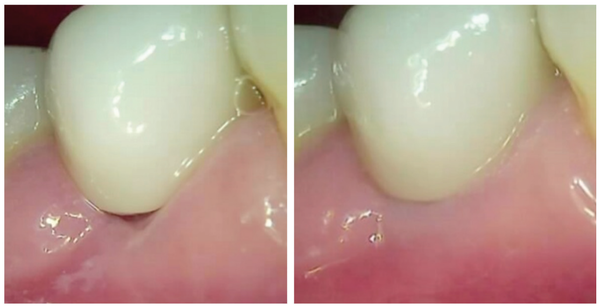 (그림 6) 협측 gingiva line의 변화