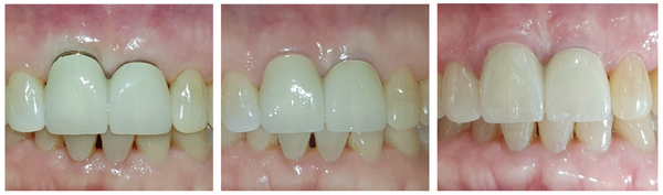 (그림 7) 순측 gingiva line의 변화