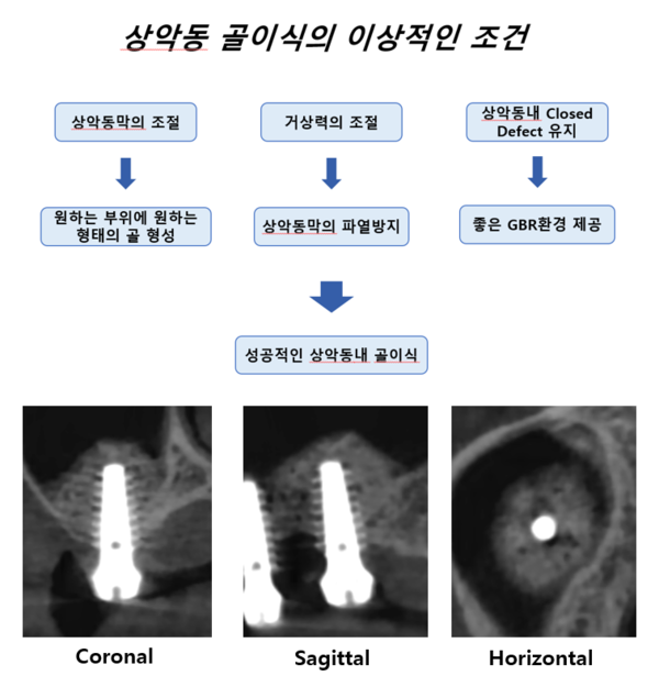 (그림 1) 상악동 골이식의 이상적인 조건