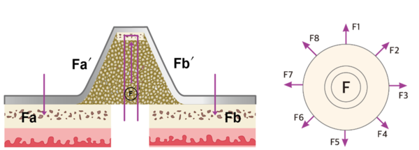 (그림 2) 둥글게 형성되는 골편과 주변의 고른 인장력 분포