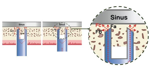 (그림 3) Magic Sinus Lifter의 경사진 blade를 통한 골편 형성
