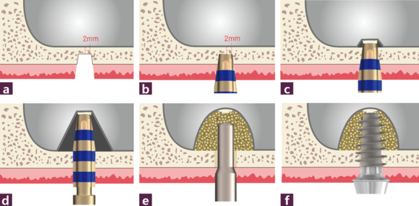 (그림 4) C.M.C technique 시행 과정