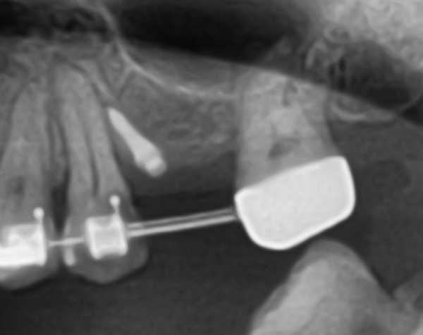 (그림 5) Magic Guide Pin 삽입 후 파노라마