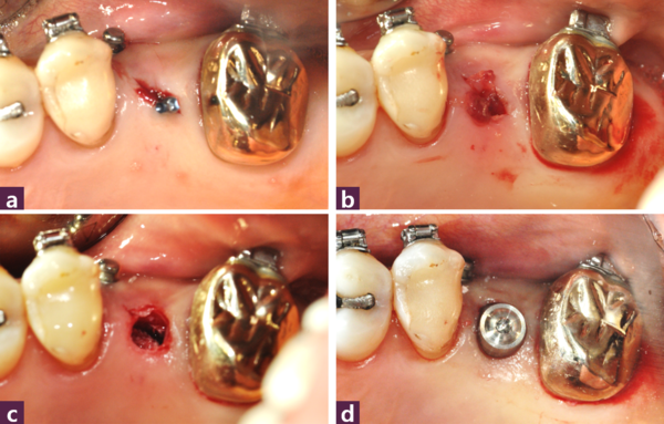 (그림 6)  C.M.C. technique을 통한 MagiCore 식립 과정 (a) Magic Guide Pin 위치, (b) 식립구 형성 후 PRF 적용, (c) 골이식 후, (d) MagiCore 식립 후