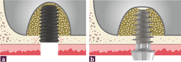 (그림 7) a. 삼각나사의 fixation에 의한 고정으로 얇은 잔존골에서 초기 안정 확보가 어려운 경우             b. 사각나사의 형태적 접촉에 의해 얇은 잔존골에서 초기 안정 확보
