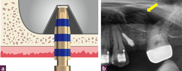 (그림 8) a. Magic Sinus Lifter가 상악동저의 골편을 잡고 원하는 만큼 상악동을 거상하는 모식도b.  술 중 파노라마. 상악동 내부의 골이식 중 사진으로 상악동 저의 골편이 거상된 것(노란 화살표)을 관찰할 수 있다