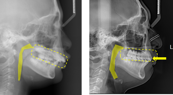 상악치열의 후방 이동 후 기도공간의 변화를 연구한 결과 치열을 후방 이동해도 기도공간은 좁아지지 않음이 입증됐다.