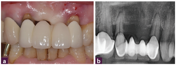 (그림 2) 12번-22번의 4-unit bridge 술 전 사진  _  ⓐ 구강 내 사진, ⓑ 파노라마