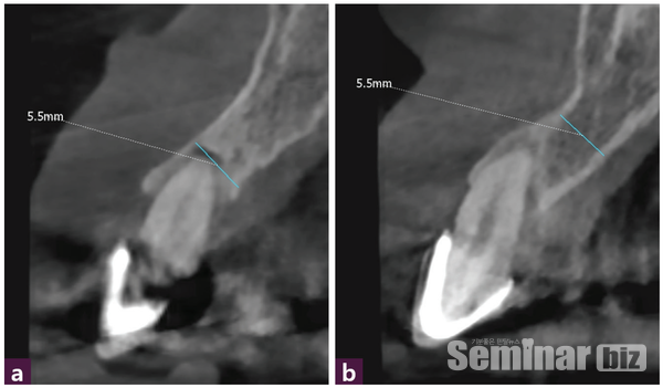 (그림 3) 술 전 CBCT _  ⓐ 12번,  ⓑ 22번