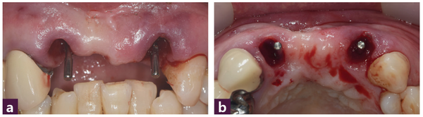 (그림 4) 12, 22번 발치와에 Magic Guide Pin 설치 후 구강 내 사진 _ ⓐ 순측면, ⓑ 교합면