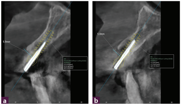(그림 5) Magic Guide Pin 설치 후 CBCT _ ⓐ 12번, ⓑ 22번