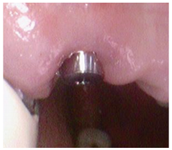 (그림 7) 12번의 Magic Post 2mm 노출 이미지