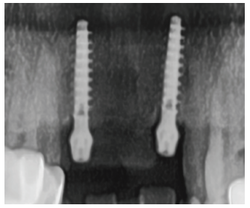 (그림 8) 12, 22번 술 후 파노라마