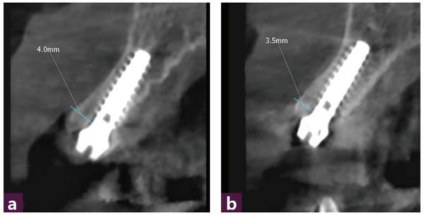 (그림 9) 술 후 CBCT _ ⓐ 12번, ⓑ 22번