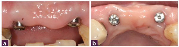 (그림 10) 식립 1개월 후 구강 내 사진 _ ⓐ 순측면, ⓑ 교합면