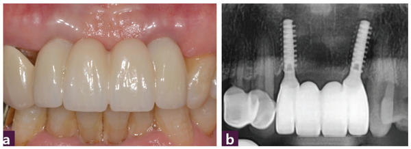 (그림 11) 식립 2개월 후 최종 보철  _ ⓐ 구강 내 사진, ⓑ 파노라마