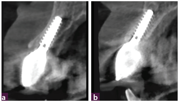 (그림 12) 식립 2개월 후 최종 보철 CBCT  _ ⓐ 12번, ⓑ 22번