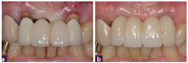 (그림 13) 12, 22번 구강 내 사진  _ ⓐ 식립 전, ⓑ 최종 보철 장착 후